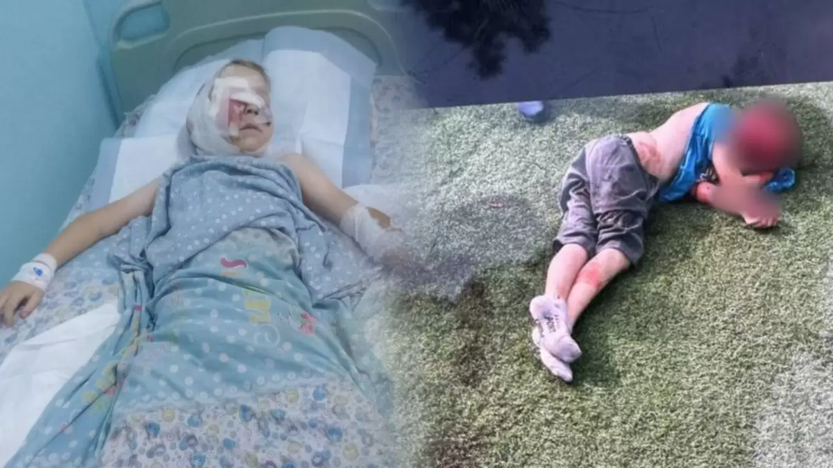 Дәрігерлер Жалпақсайда ит өлімші етіп талап кеткен баланың қазіргі жағдайын айтты